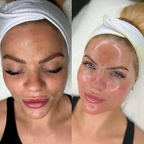 FACIALS IN DENVER, CO